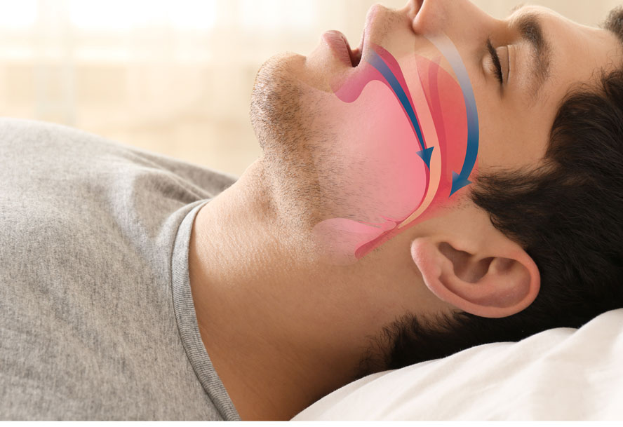 Sleep Apnea Douglasville, GA