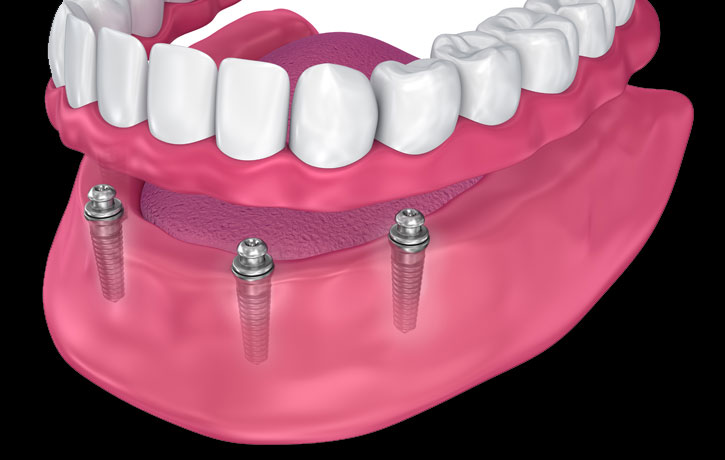 Implant Supported Dentures Douglasville, GA