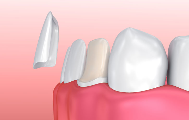 Porcelain Veneers Douglasville, GA