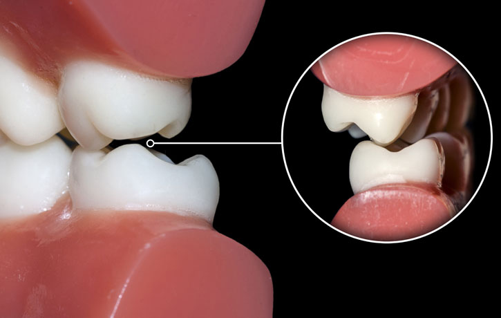 Teeth Grinding Douglasville, GA