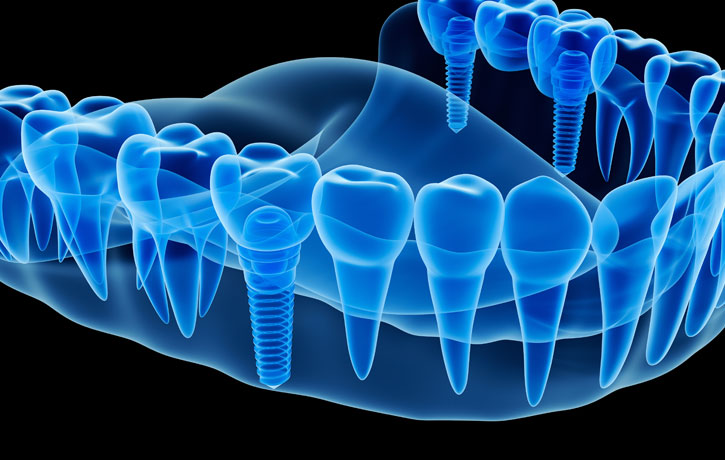Dental Implants Douglasville, GA