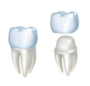 Dental Crown Illustration - Douglasville, GA